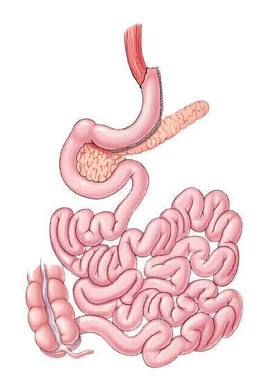 Gastric Sleeve diagram